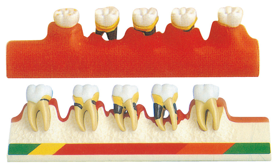 치주병 모형은 치과 학교 훈련을 위한 5개 부품을 포함합니다