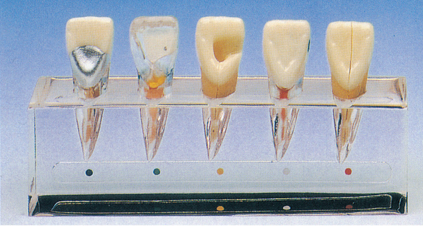 치과 학교 훈련을 위한 5개 부품 대략 임상 이 질병 시리즈 모형